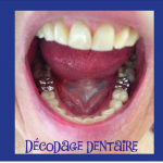 Décodage dentaire 2