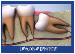 décodage dentaire 18